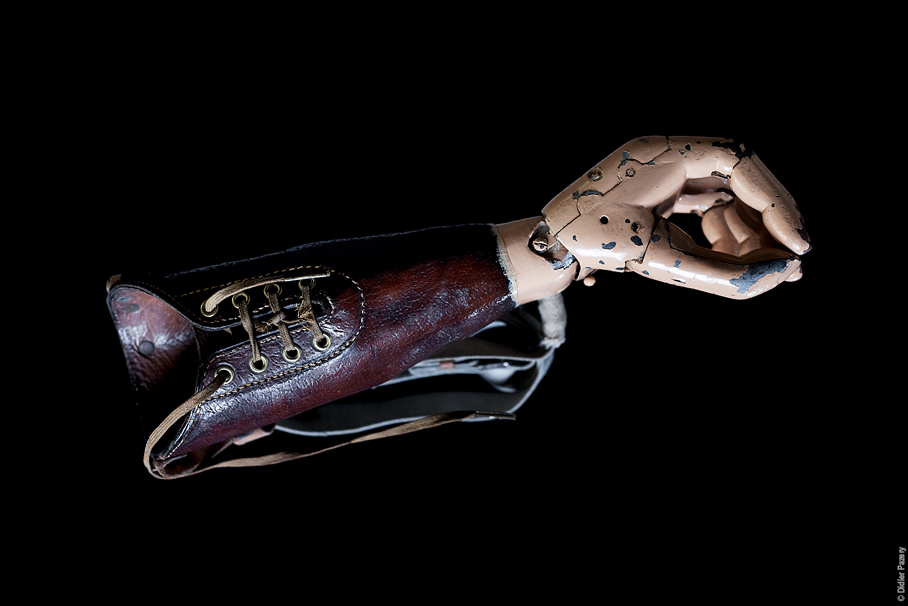 Prosthetic forearm with an articulated hand, known as an “American prosthesis”